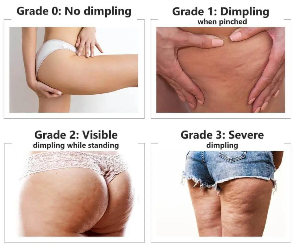 Representation of the stages of cellulite development Leighton Buzzard